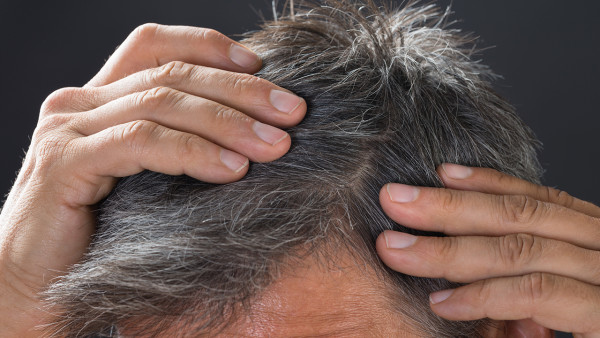 头发发际线过高怎么办？5个方法拯救你的发际线