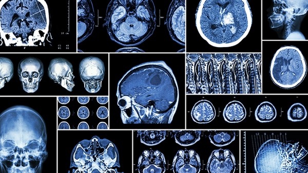 脑干腔隙性脑梗塞的症状都有哪些脑 腔隙性脑梗塞该如何进行治疗