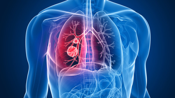 肺癌的放疗是什么