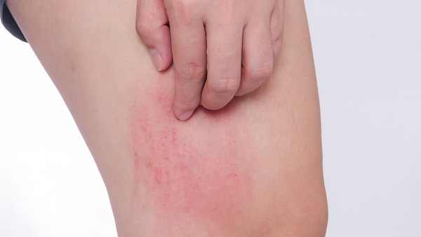 皮肤划痕荨麻疹怎么办