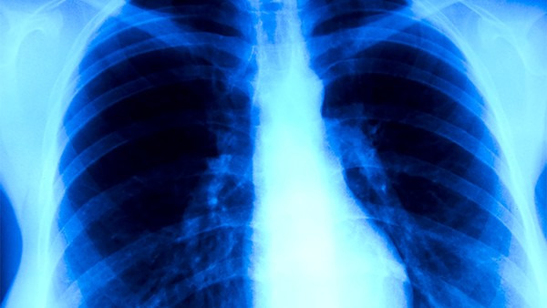 肺大泡会变成肺癌吗