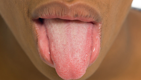齿痕舌会自愈吗