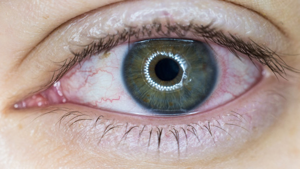 眼皮浮肿是什么原因