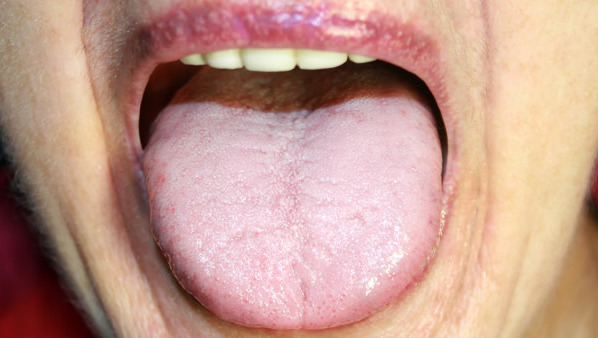 舌头上有齿痕是怎么回事
