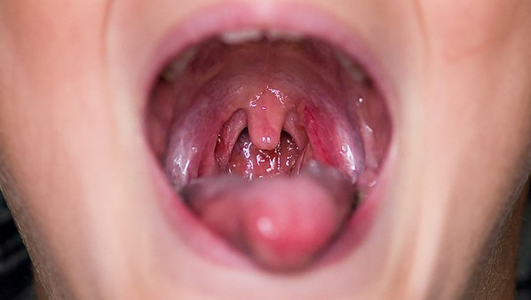 喉咙有异物感怎么办