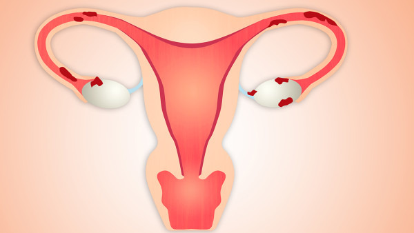 如何诊断出子宫内膜异位症