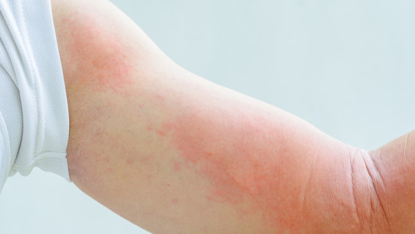 急性荨麻疹该怎么办