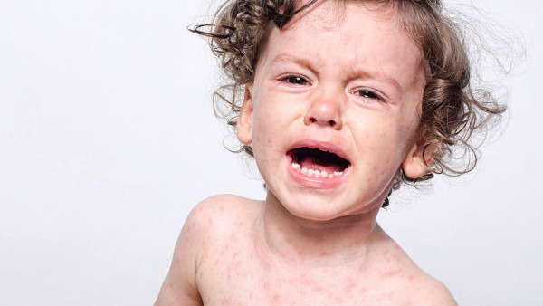 慢性荨麻疹有什么危害